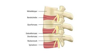 Bandscheibenvorfall - Wann ist eine OP sinnvoll? | apomio Gesundheitsblog