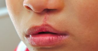 Häufige Fehlbildungen: Lippen-Kiefer-Gaumenspalte | apomio Gesundheitsblog