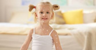 Windpocken bei Kindern und Erwachsenen | apomio Gesundheitsblog