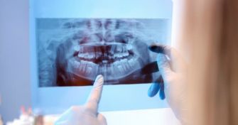 Chaos im Mund: Zahnfehlstellungen im Überblick | apomio Gesundheitsblog