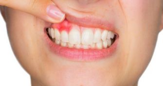 Zahnfleischentzündung: Gingivitis erkennen und behandeln | apomio Gesundheitsblog