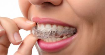 Wenn die Zähne wandern: Zahnspangen im Überblick | apomio Gesundheitsblog