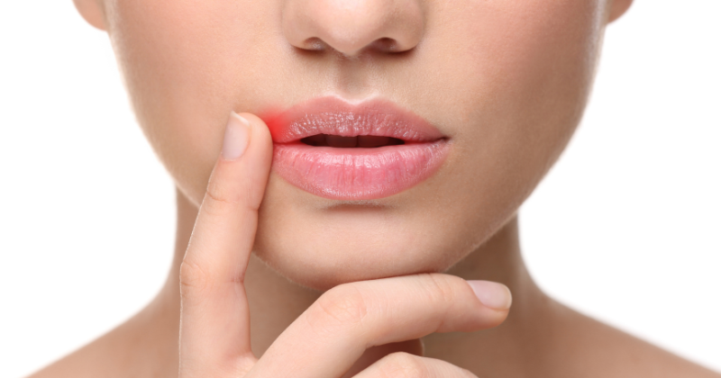 Lippenherpes: lokale Behandlungsmöglichkeiten im Vergleich | apomio Gesundheitsblog