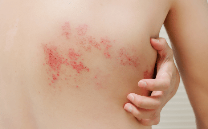 Borreliose: Auslöser, Übertragungsweg, Symptome, Therapie und Impfung
