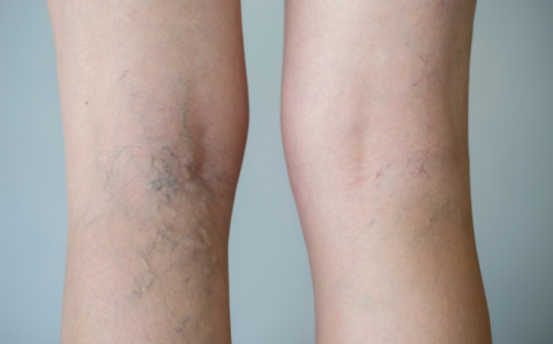 Der Unterschied zwischen einem unauffälligem Bein und hervortretenden Venen links - apomio.de Gesundheitsblog