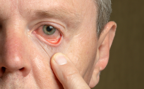 Myasthenia gravis führt häufig zu hängenden Augenlidern - apomio.de Gesundeitsblog