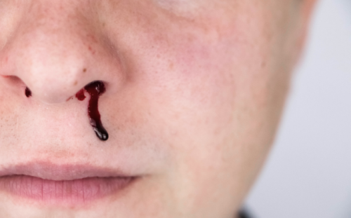Nasenbluten kann ein Symptom zu hohen Blutdrucks sein - apomio.de Gesundheitsblog